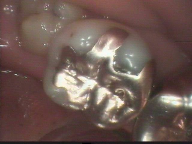 大臼歯の感染根管治療はとても根気がいる治療ですが、今回は2本の大臼歯の根管治療を同時に行いました。