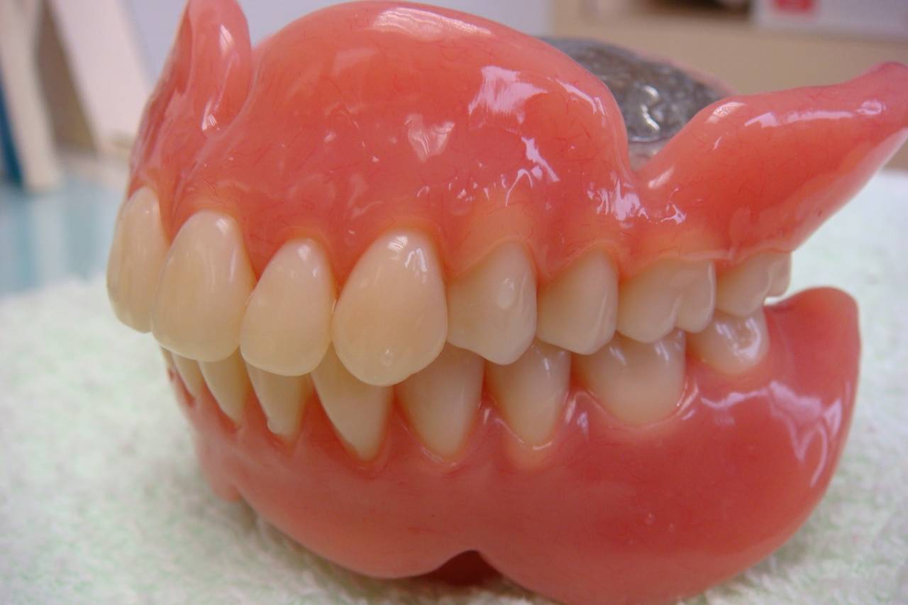 総入れ歯の症例です。１２年前に嘔吐反射に対応した総入れ歯です。これは大変に難しい治療です。総入れ歯に大事な部分を削除した形にしなければならないからです。幸にしてうまく対応出来て、今もなお良く咬めて活躍しています。