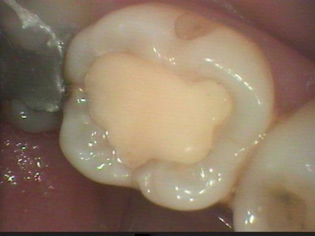 隣の歯との間に細菌が貯留したままだったので、ここが虫歯になりました。ここの接着性審美充填はテクニックが求められます。